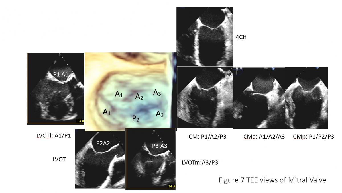 Catheter Based Mitral Intervention Imaging And Procedural Tee Ctsnet